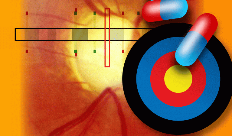 Genetic variants in a gene called ANGPTL7 reduce the risk of glaucoma