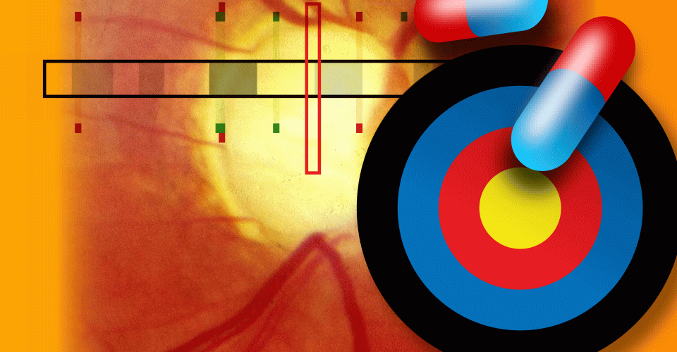 Genetic variants in a gene called ANGPTL7 reduce the risk of glaucoma