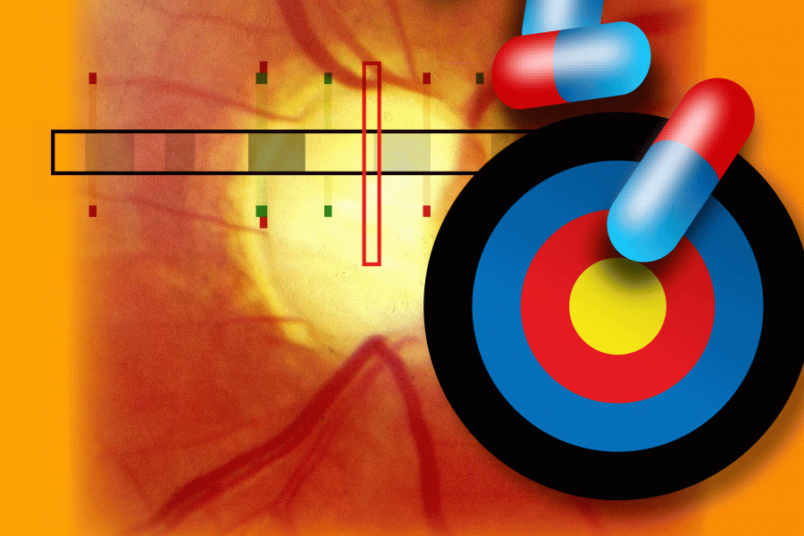 Genetic variants in a gene called ANGPTL7 reduce the risk of glaucoma